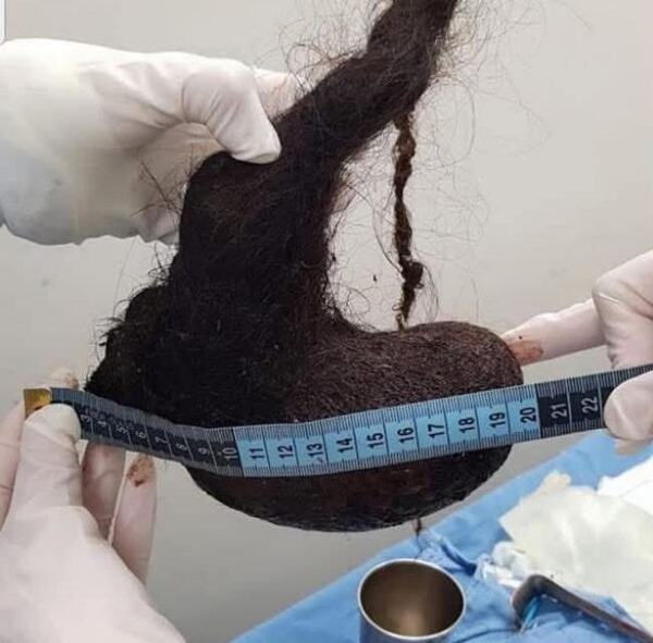 Operan a menor de Yucatán que padecía el extraño Síndrome de Rapunzel
